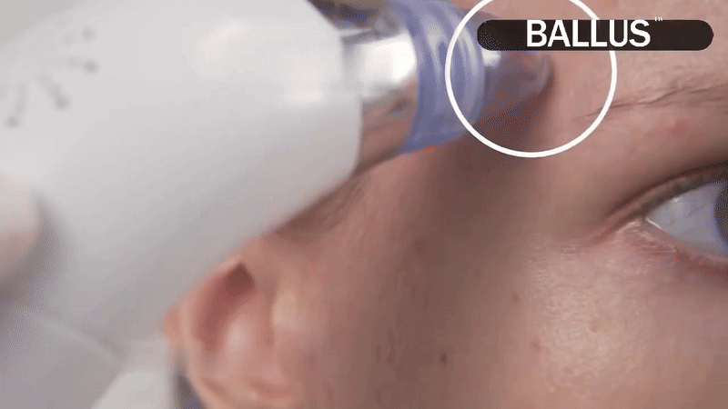 Pore Cleaning Device Noon Marrt